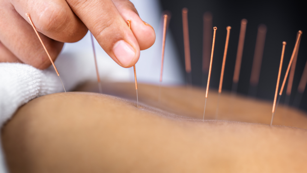 acupuncture